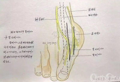 下图讲述第一跖趾关节背内侧入路,拇指跖趾关节背侧和背内侧切口,第2