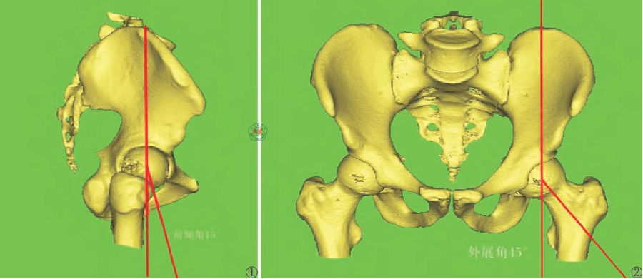图1三维重建髋臼前倾角示意图图;2三维重建髋臼外展角示意图