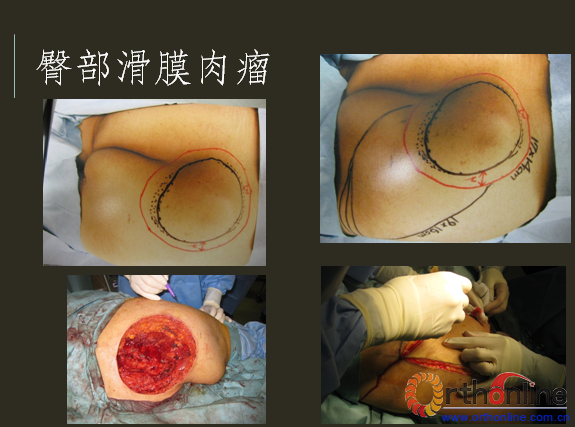 软组织肉瘤的治疗