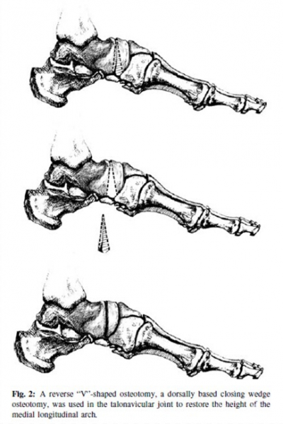 perinaviculararthrodesisforthestageiiimüllerweissdisease