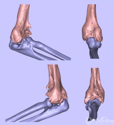 ct三維成像顯示骨化部位以肘關節前外側及後內側為主,鷹嘴窩被骨化