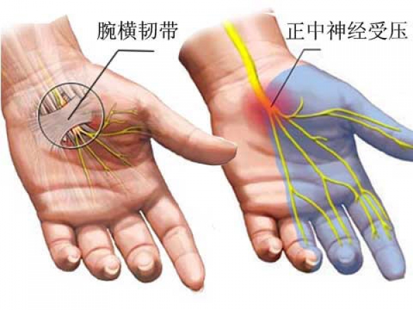 尺神经半脱位图片