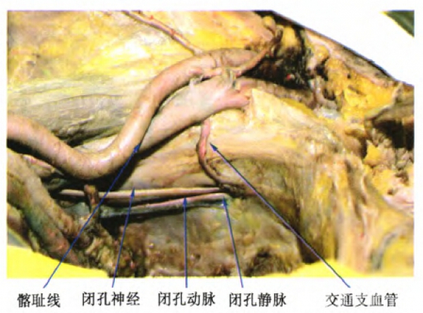 圖3 閉膜孔周圍解剖結構髂內動脈在發出閉孔動脈前,分出髂腰動脈,經骶