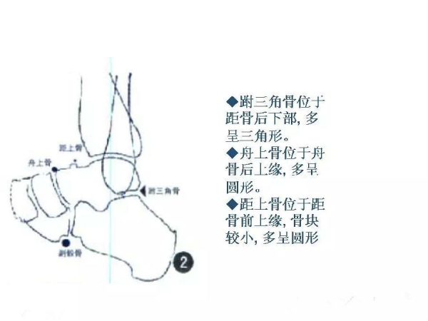 鑑別要點籽骨副骨永存性骨骺以及撕脫性骨折