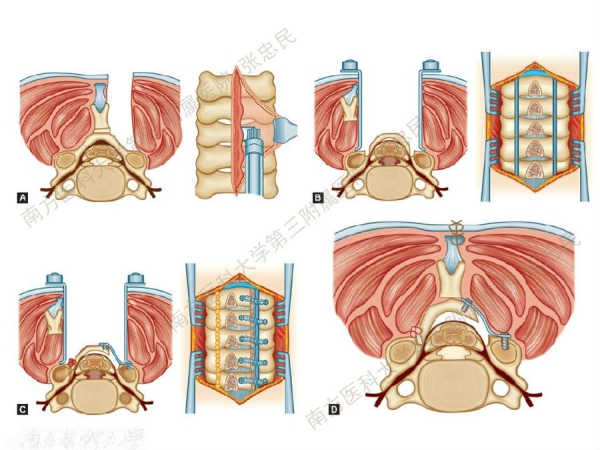 颈椎后路开门技术与争议