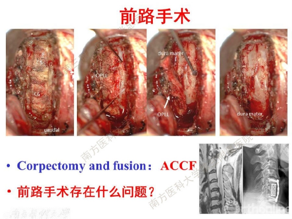 颈椎后路开门技术与争议