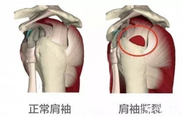 圖3:肩袖損傷示意圖,圖中箭頭所指為肩袖撕裂凍結肩和肩袖損傷的治療