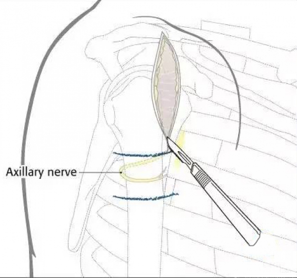 切開喙肩韌帶蒂,鈍性分開三角肌;弧形切口肩上騎,鈍性推開肩峰皮.