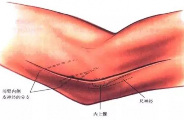 肘後外側入路1起自肱骨外上髁,沿著皮紋向下走;直接越過橈骨頭,五六