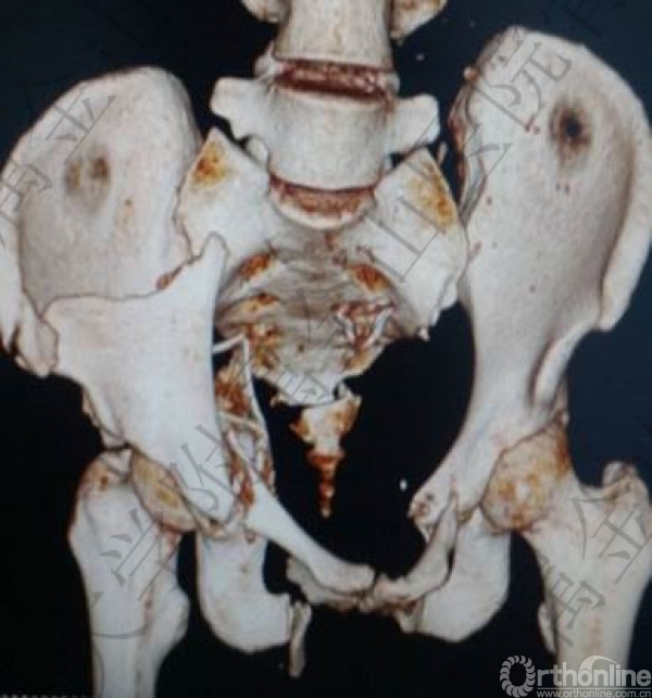 病例汇报不稳定骨盆骨折抢救与治疗