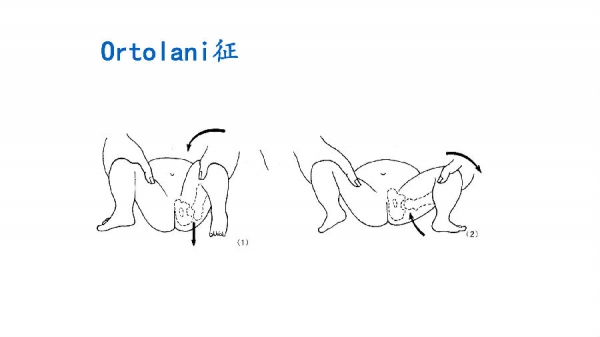 (5)望远镜试验:检查者一手握住大腿远端,另一手拇指和其余四指置于