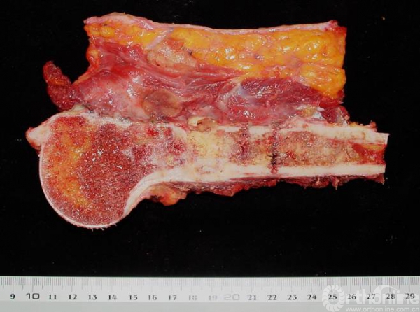 病例一第二次手术术后大体病理镜下表现术后治疗方案诊断骨肉瘤明确