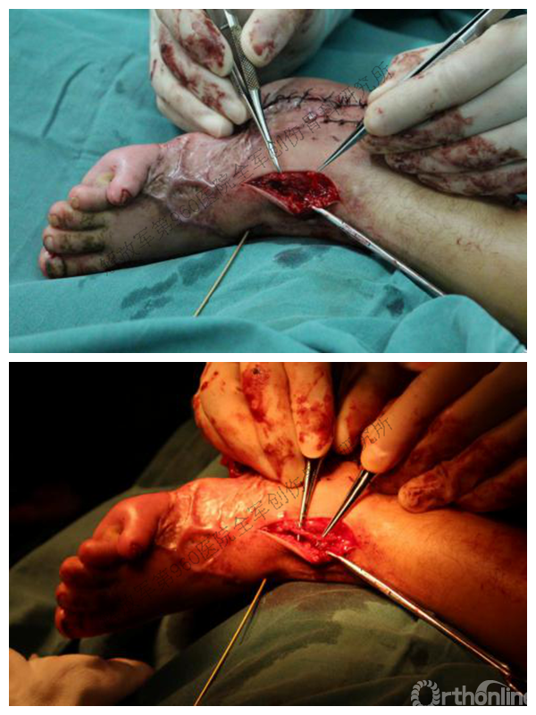 硬气解放军第960医院填补世界幼儿足跟再造手术空白