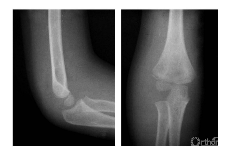 肱骨远端骨骺x线图片图片