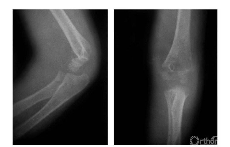 肱骨远端骨骺x线图片图片
