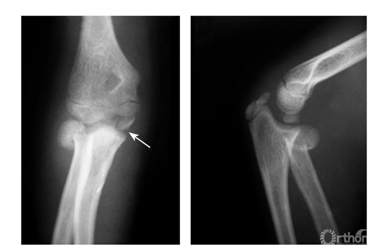 骨科常见疾病x线解析之肱骨内上髁骨折
