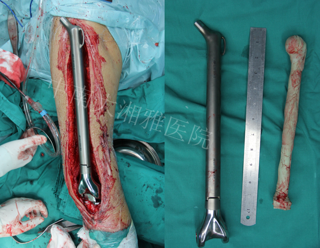 中南大学湘雅医院全股骨置换病例讨论