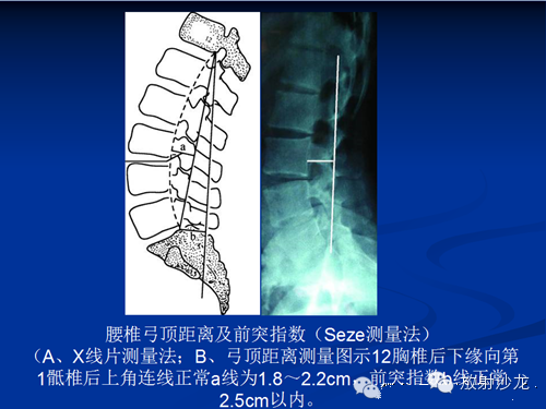 6.腰骶角的测量7.脊柱侧弯的测量