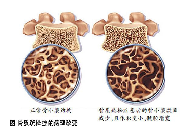 骨小梁紊乱图片