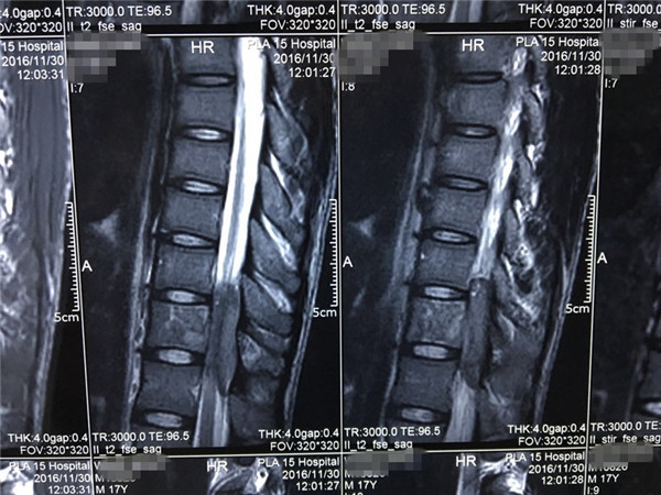 4术前 MRI_副本.jpg