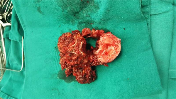 6术中 椎体切除.jpg