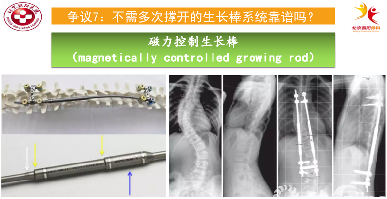 结语:生长棒技术治疗早发性脊柱侧凸目前还是一个相对安全有效的手术