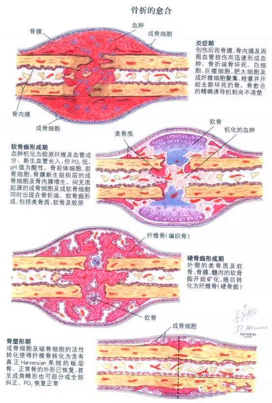 成纤维细胞,骨前体细胞修复期:骨痂形成(硬骨痂或软骨痂,编织骨形成