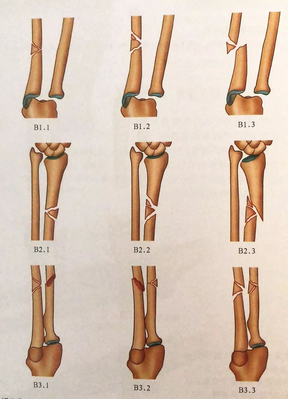 尺桡骨骨折分型图片图片