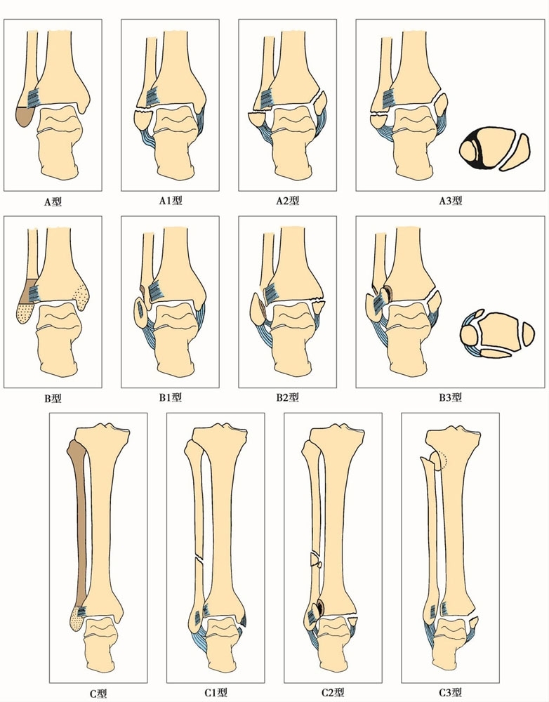 胫腓骨骨折分类图片图片