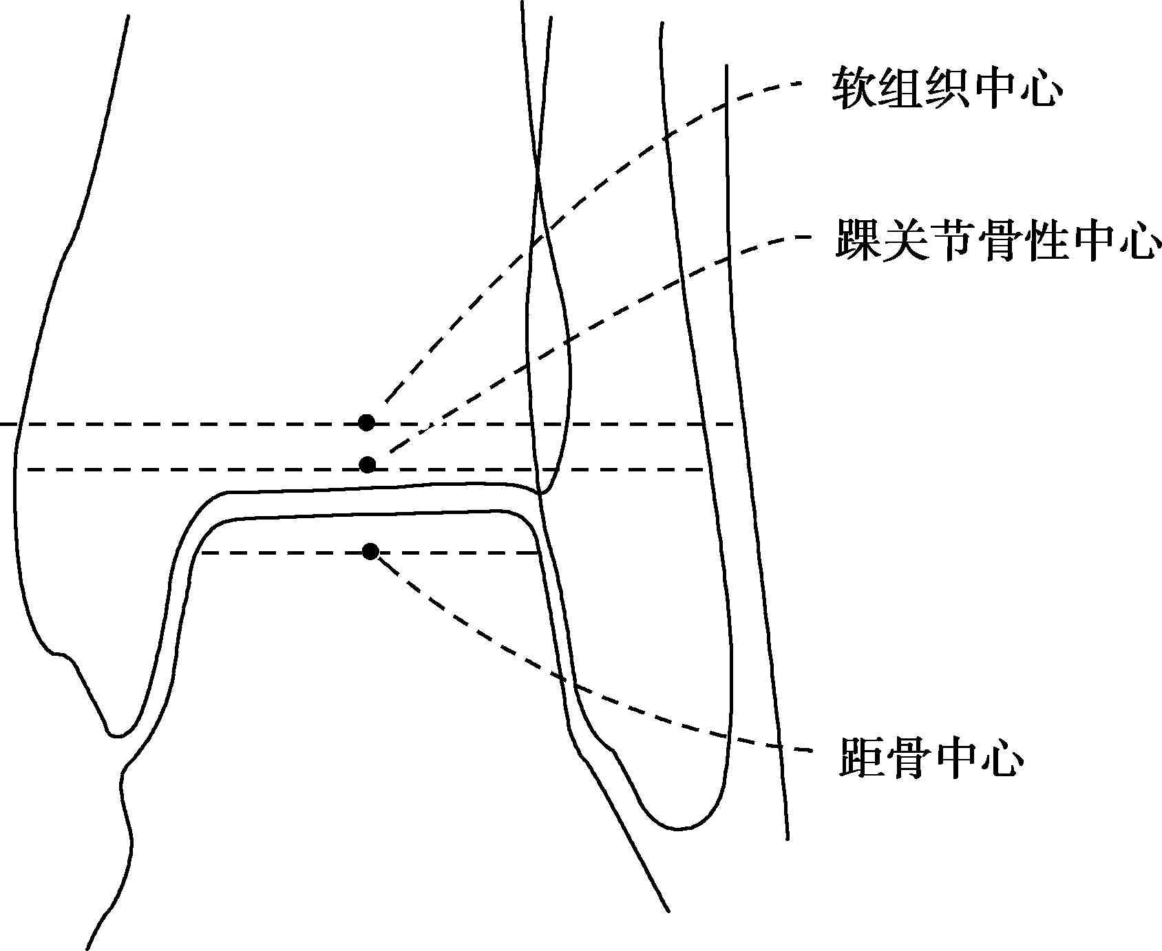 下肢力线示意图图片