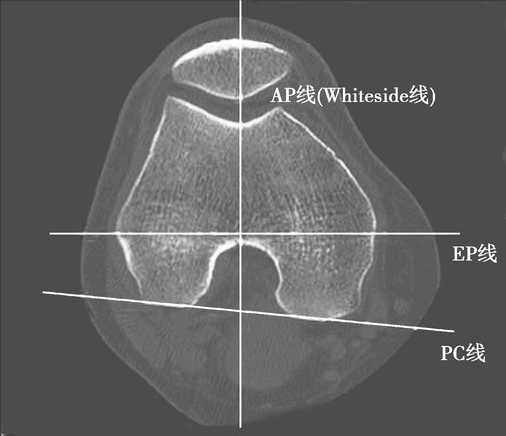 如何根据x线测量下肢力线