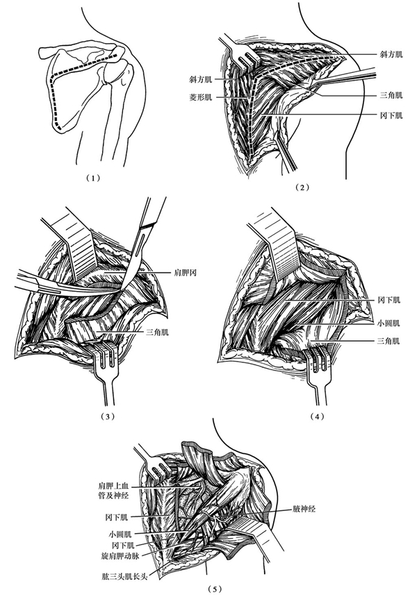 肩胛骨背侧显露手术路径
