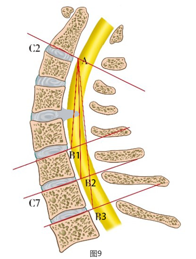 脊髓線sc線及其分型在頸椎外科手術中的應用