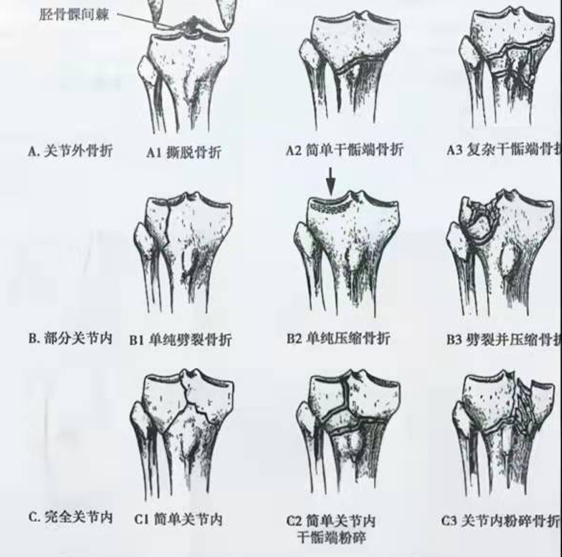 胫骨骨折分类的图片图片