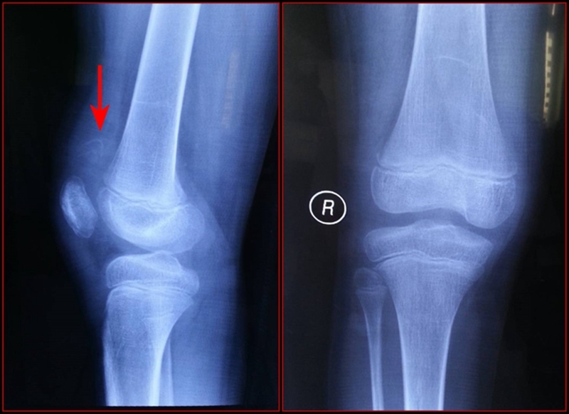 儿童髌骨x线图片图片