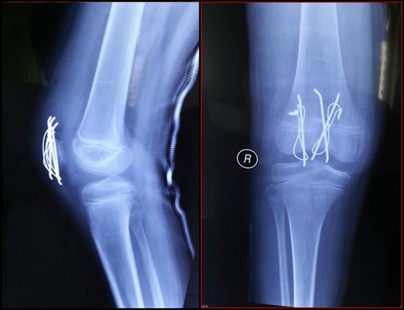 病例解析儿童髌骨套状撕脱骨折还会漏诊吗