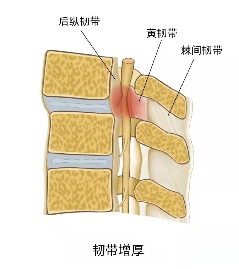 黄韧带与硬脊膜图片